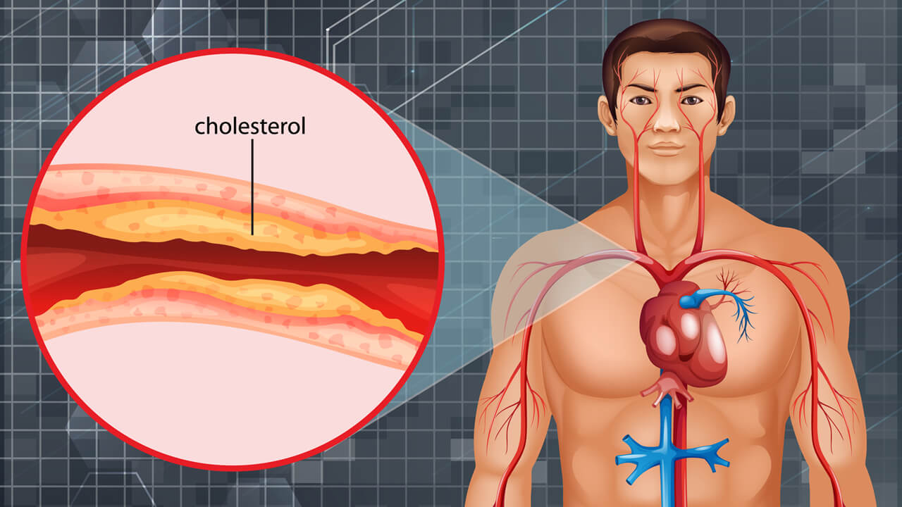 කොලෙස්ට්‍රෝල් හඳුනා ගැනීම