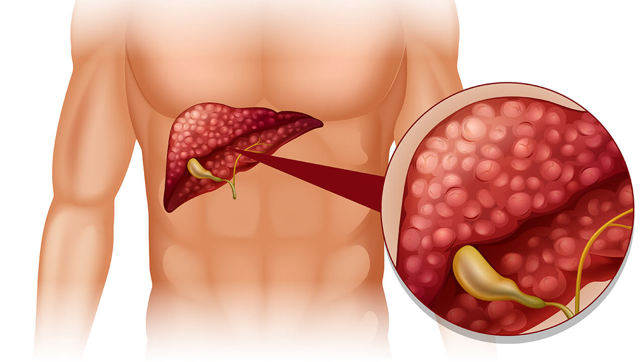 What is Fatty Liver?